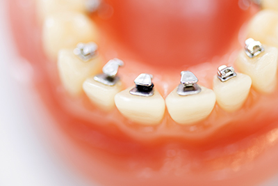 永久歯列の矯正治療